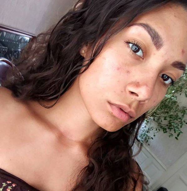 12 Beautiful Images of Real Womens Acne Scars - 1