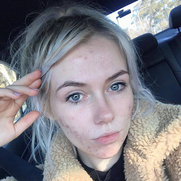 12 Beautiful Images of Real Womens Acne Scars - 2