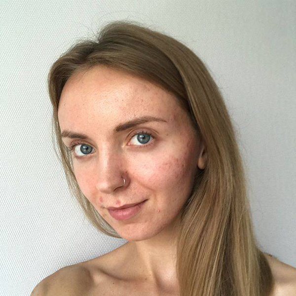 12 Beautiful Images of Real Womens Acne Scars - 4