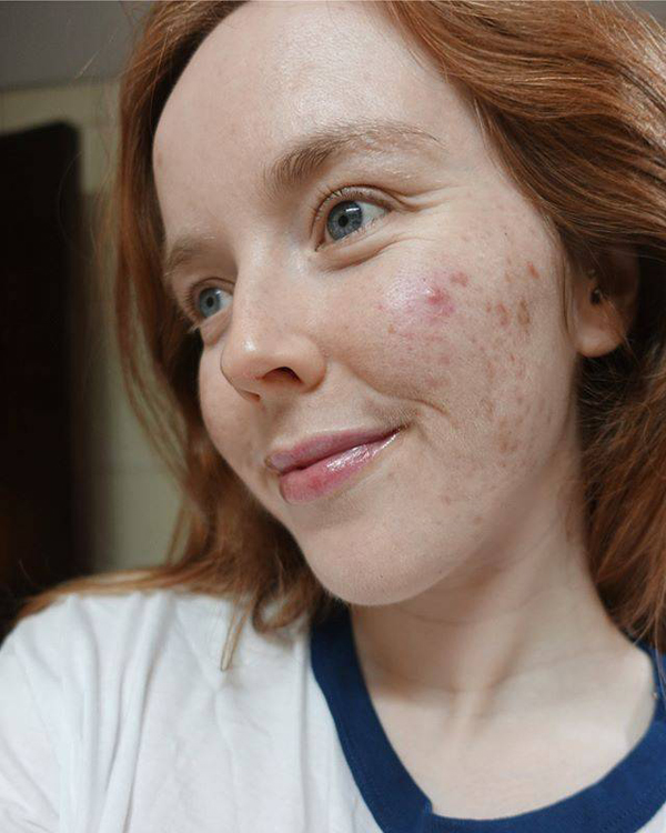 12 Beautiful Images of Real Womens Acne Scars - 8