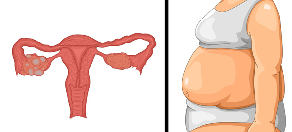 Hội chứng buồng trứng đa nang Hội chứng buồng trứng đa nang (PCOS) ảnh hưởng đến phụ nữ ở thời kỳ tiền mãn kinh với đặc điểm là tình trạng mất cân bằng hormone.