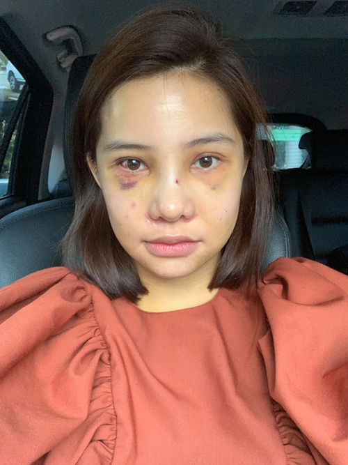 7 ngày sau khi đập mặt đi xây lại, Lưu Đê Ly có thể hồi phục sức khỏe và trở về Việt Nam. Gương mặt của cô lúc này vẫn còn sưng, bầm tím tuy nhiên không bị đau đớn.