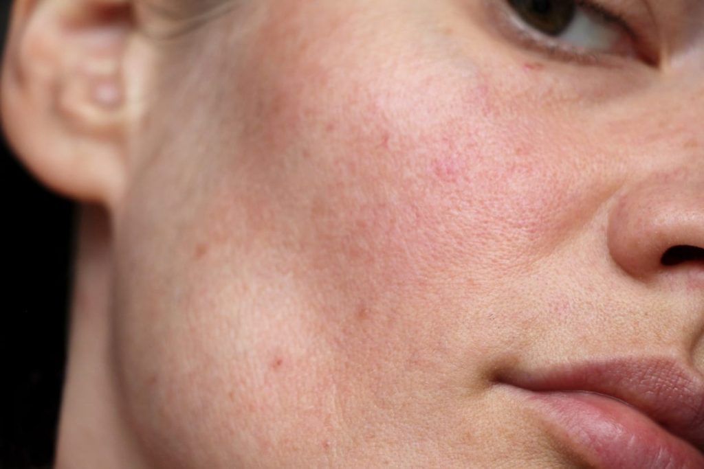 Bức tranh toàn cảnh về làn da khi bạn quá lạm dụng treatment: AHA, BHA Bức tranh toàn cảnh về làn da khi bạn quá lạm dụng treatment: AHA, BHA